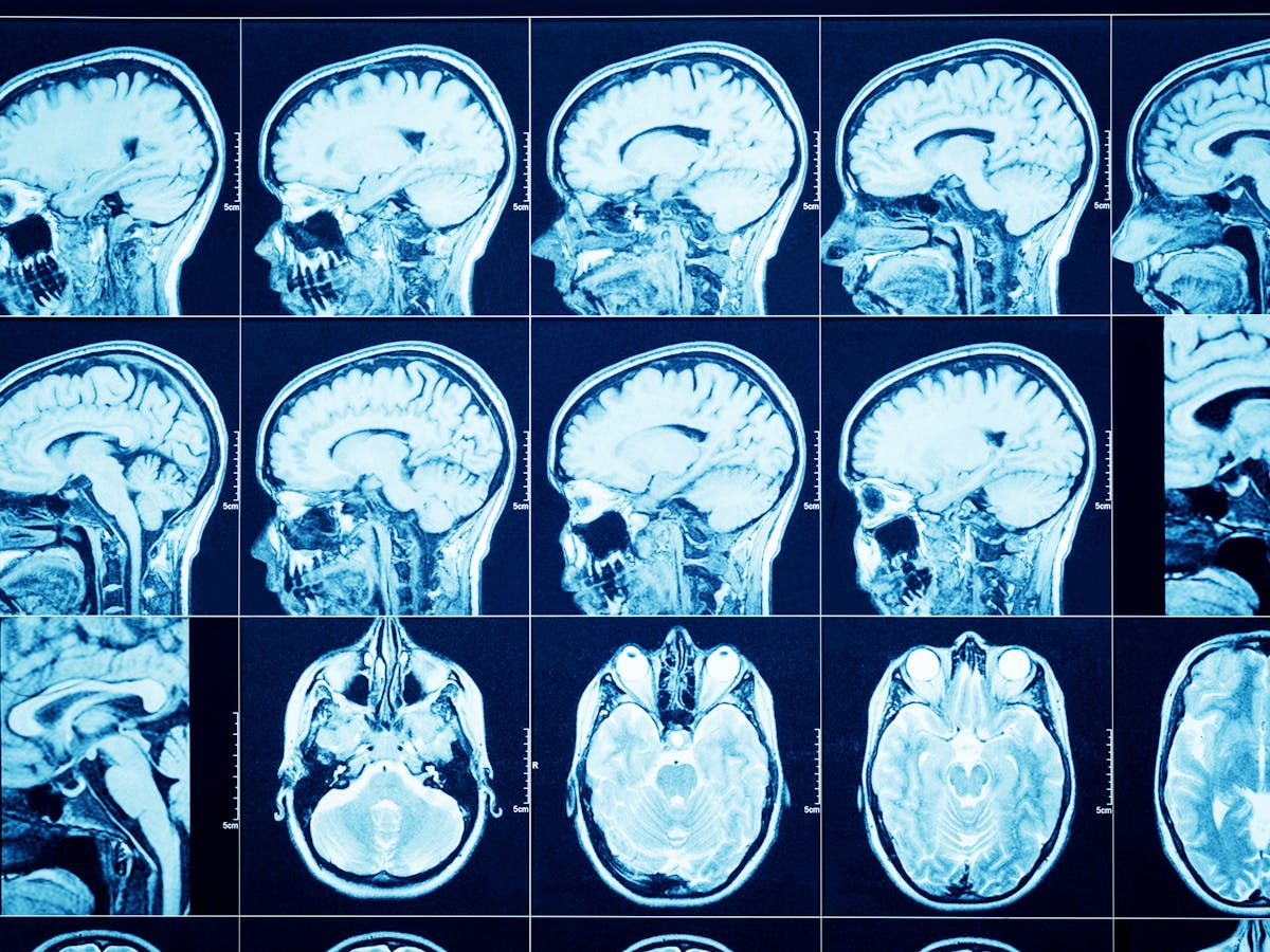 Coronavirus Many Patients Reporting Neurological Symptoms