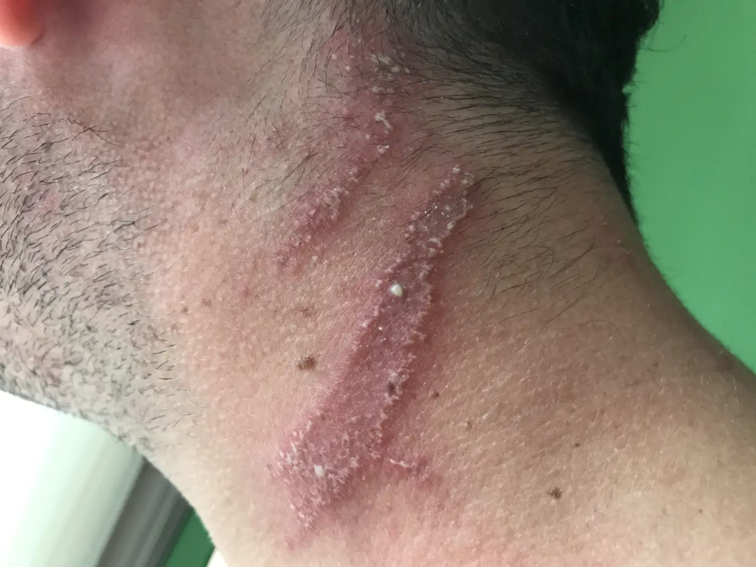 Beetle Rash Nairobi flies: unpacking the mystery of a small beetle with huge burn power