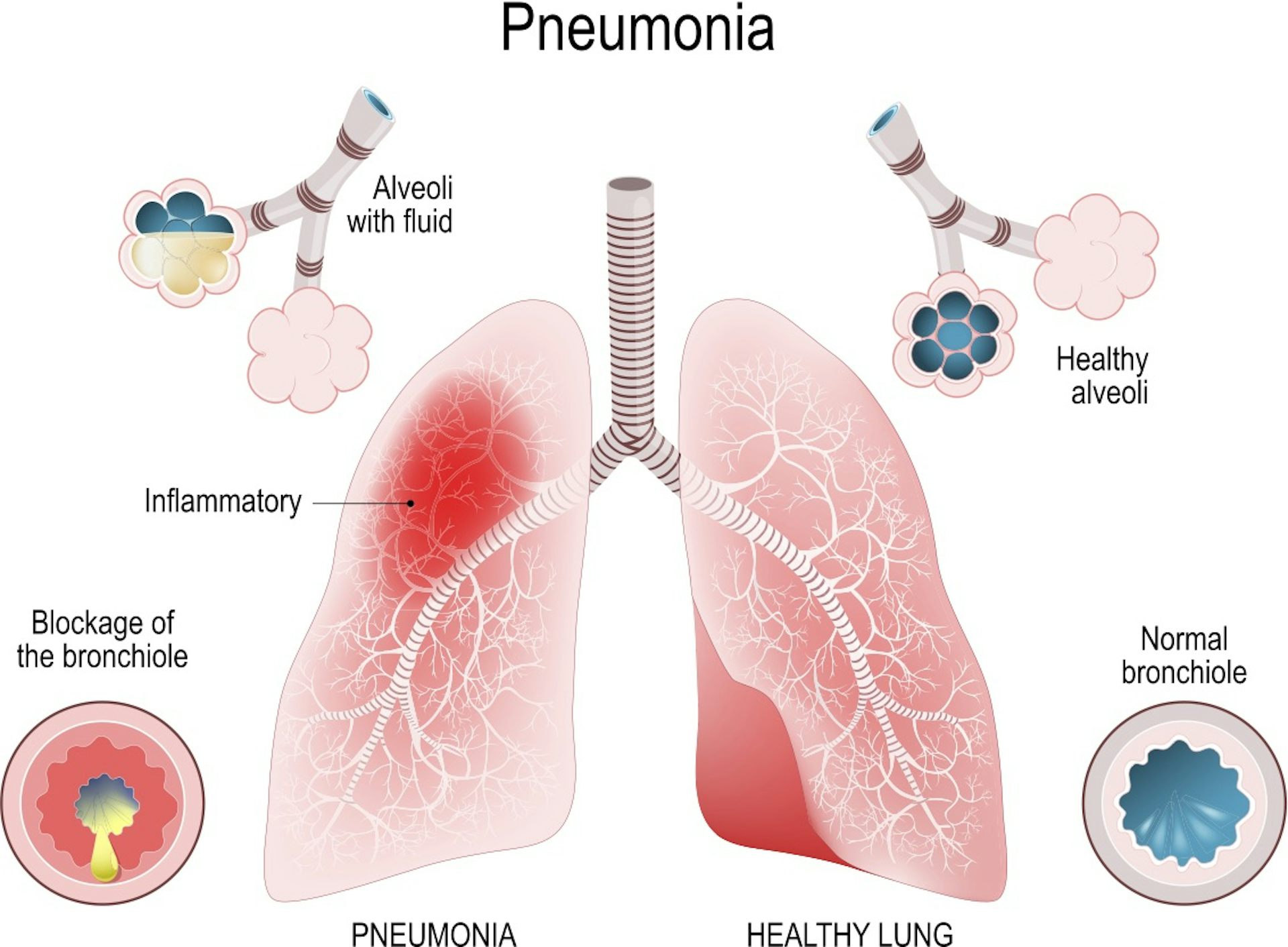 how to treat viral pneumonia covid