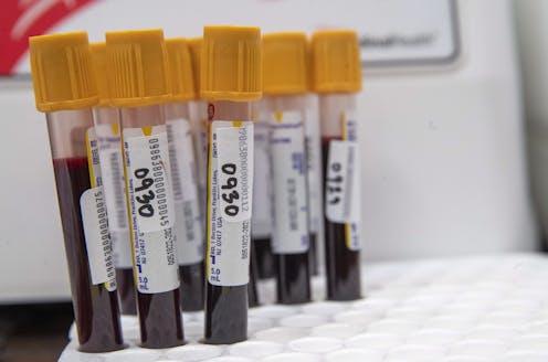 Can Antibody Tests Tell Us Who Is Immune To Covid 19