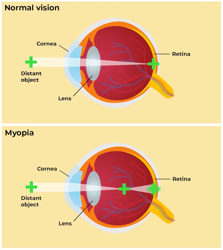 video glaucoma myopia