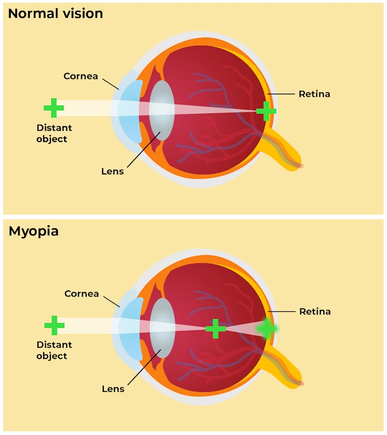 Increasing screen time during COVID-19 could be harmful to kids' eyesight