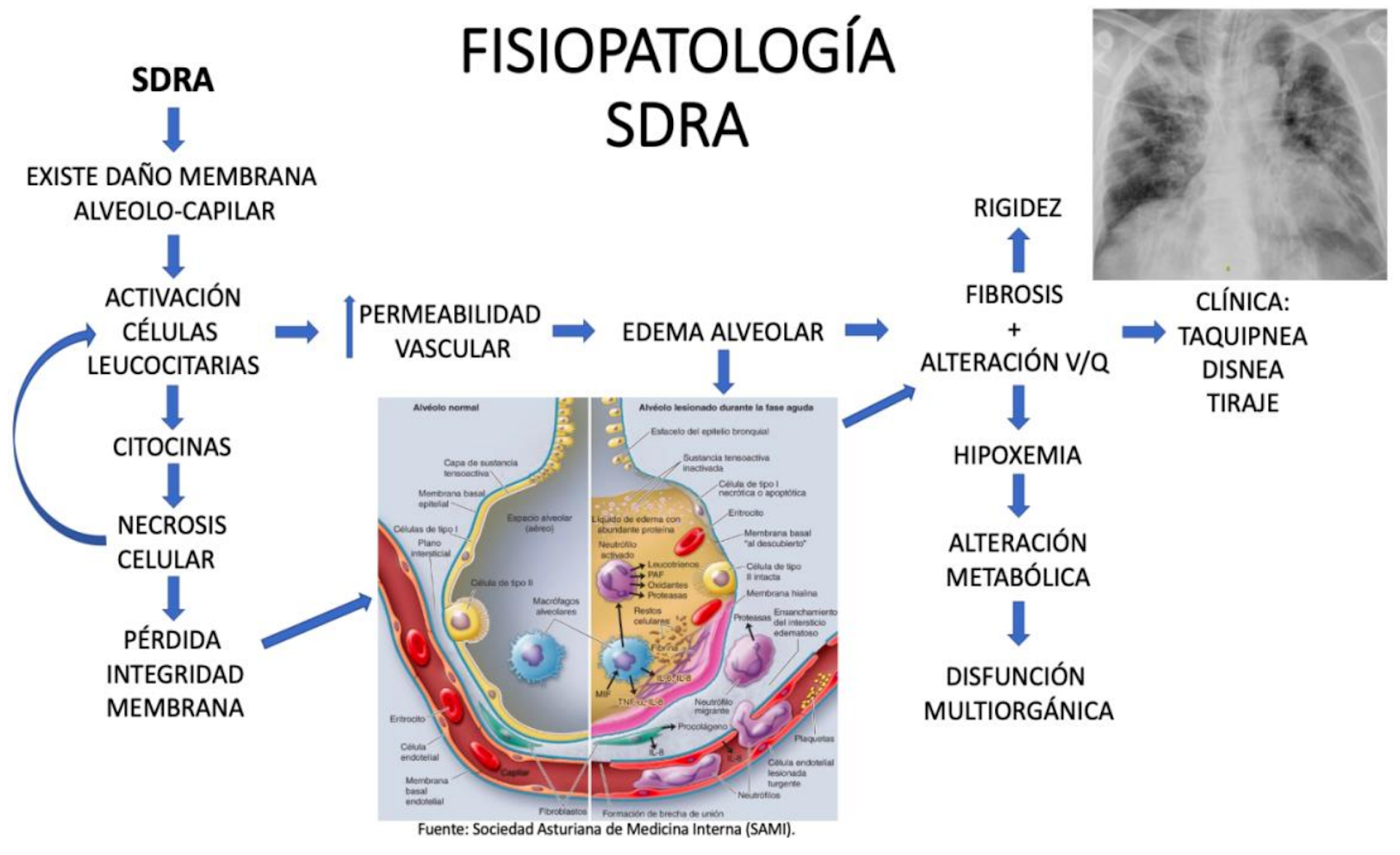 COVID-19: Por Qué Es Bueno Colocar 'bocabajo' A Los Pacientes Con ...