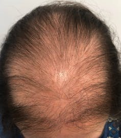 Incorporar de primera categoría Calor Las mujeres también sufren la alopecia: estos son los mejores tratamientos