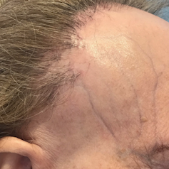 Las Mujeres Tambien Sufren La Alopecia Estos Son Los Mejores Tratamientos