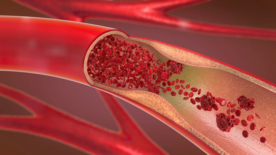 Repurposing Alzheimer S Drugs Could Prevent Blood Vessel Damage Repurposing Alzheimer S Drugs Could Prevent Blood Vessel Damage