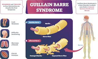 Rare Neurological Disorder Guillain Barre Syndrome Linked To Covid 19 Rare Neurological Disorder Guillain Barre Syndrome Linked To Covid 19
