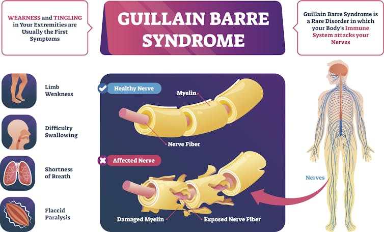Síndrome de Guillain-Barré, raro trastorno neurológico relacionado con COVID-19
