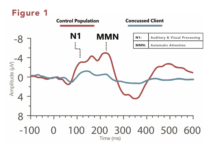 Line graph with time as x-axis and amplitude as y-axis, showing a red line for brain waves of a control patient and a blue line for a concussed patient. Red line has greater amplitude variation than blue, with N1 and MMN points much higher.