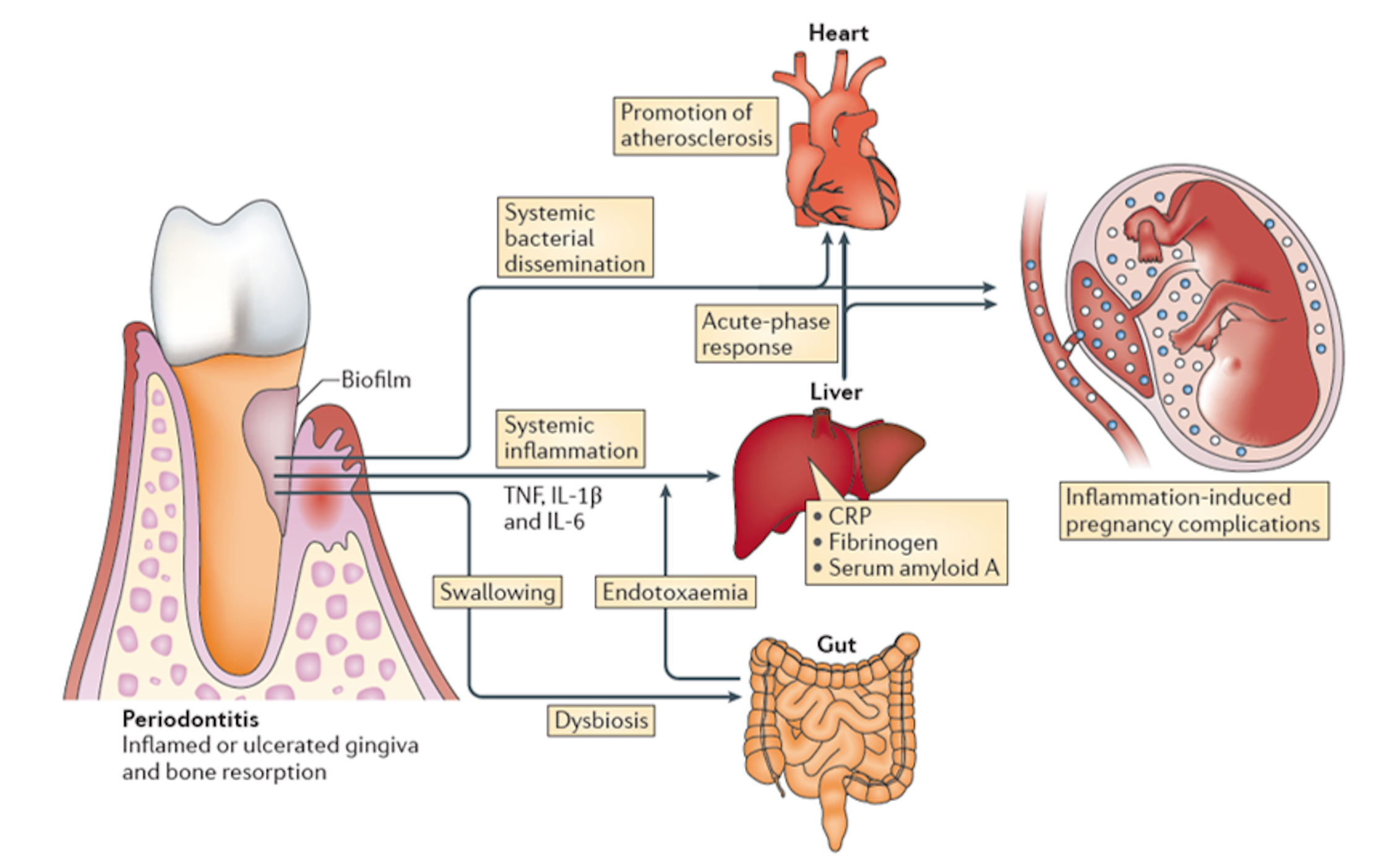 Полость заболевания легких. Микрофлора ротовой полости. Микробиота полости рта. Сердце и зубы взаимосвязь. Бактерии ротовой полости человека.