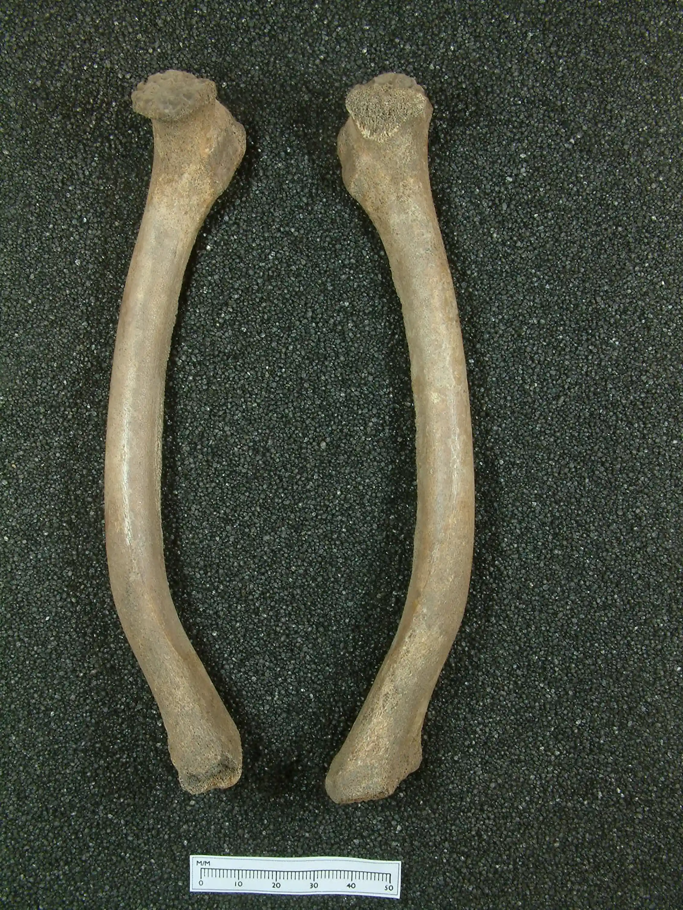 Child malnutrition: lessons from the Victorian age