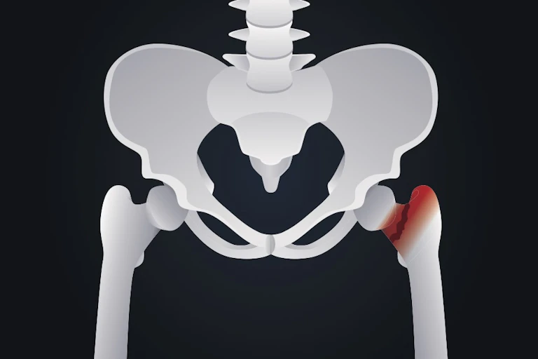 X-ray showing a hip fracture
