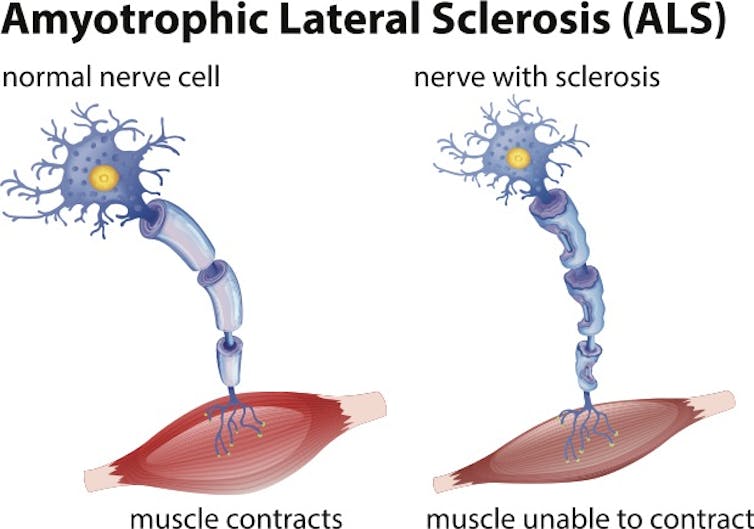 ALS scientific breakthrough: Diabetes drug metformin shows promise in mouse study for a common type of ALS