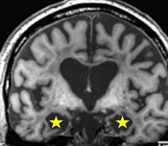 cerebro estructura más compleja