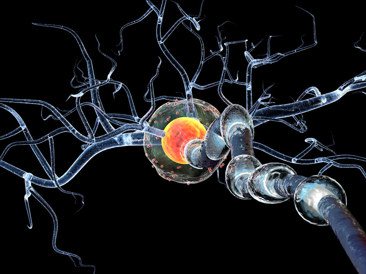 Sindrome De Guillain Barre Raro Trastorno Neurologico Relacionado Con Covid 19 Sindrome De Guillain Barre Raro Trastorno Neurologico Relacionado Con Covid 19