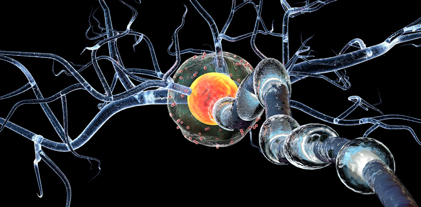 Sindrome De Guillain Barre Raro Trastorno Neurologico Relacionado Con Covid 19 Sindrome De Guillain Barre Raro Trastorno Neurologico Relacionado Con Covid 19