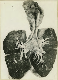 Fotografía de 1919 en la que se ven en blanco y negro unos pulmones que muestran una estenosis en la tráquea tras la inhalación de gas mostaza.