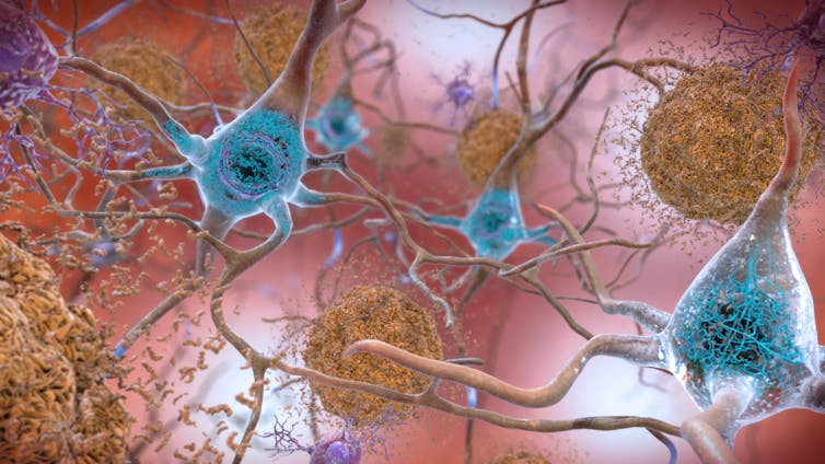 An illustration of beta amyloid and tau proteins among neurons in the brain.