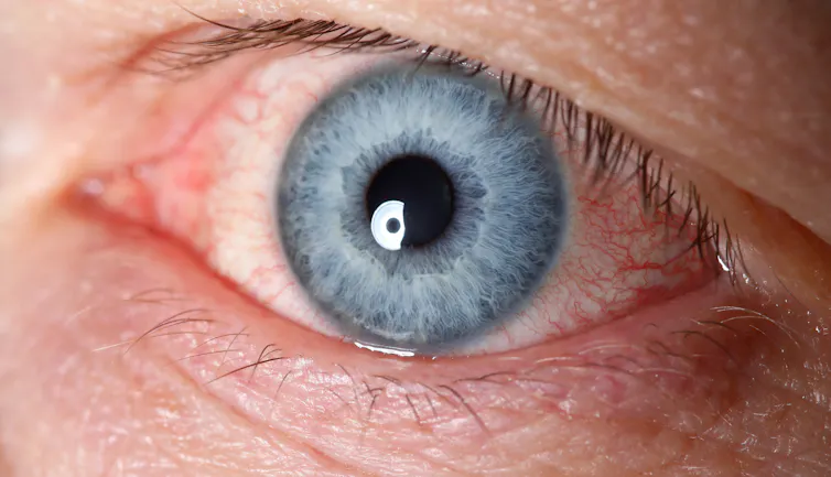 Close-up of a very bloodshot blue eye