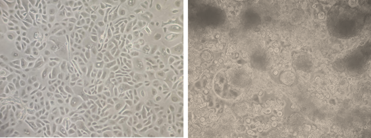 Healthy human lung cells (left) compared to virus-infected cells.