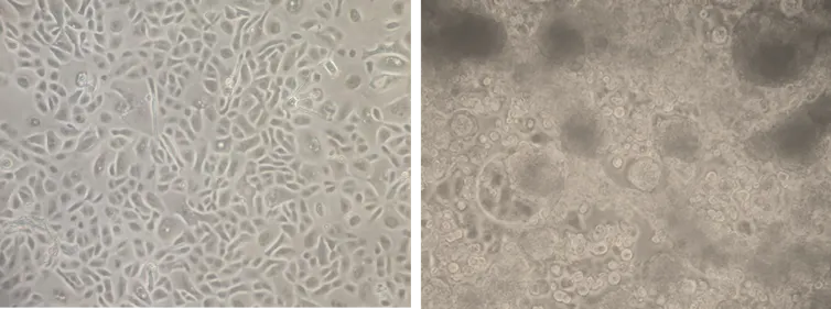 Healthy human lung cells (left) compared to virus-infected cells.