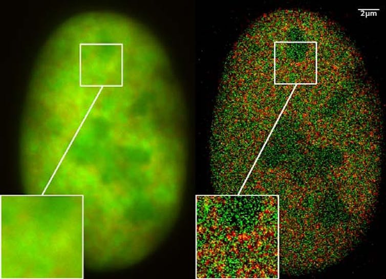 Bone cancer cell nucleus with normal high resolution fluorescence microscopy (left) and after super resolution processing (right).
