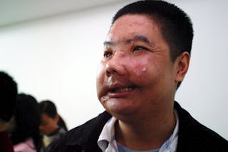 Photo d'un homme avec une greffe de visage.