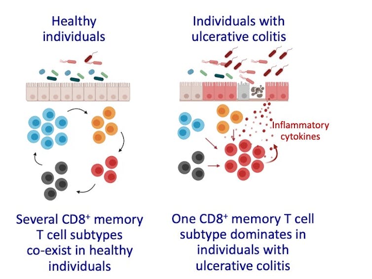 IBD: How a class of killer T cells goes rogue in inflammatory bowel disease