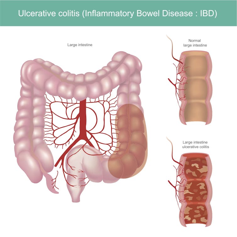 IBD: How a class of killer T cells goes rogue in inflammatory bowel disease