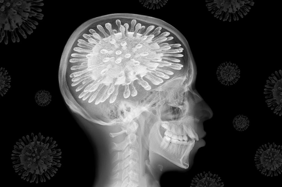 X-ray tengkorak dengan virus corona menggantikan otak.