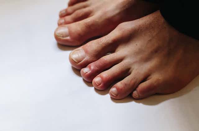 Could it be COVID toes? Red toes