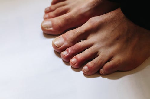 8 ways the coronavirus can affect your skin, from COVID toes, to rashes ...