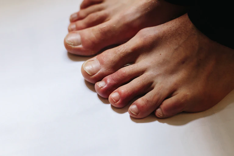 Could it be COVID toes? Red toes