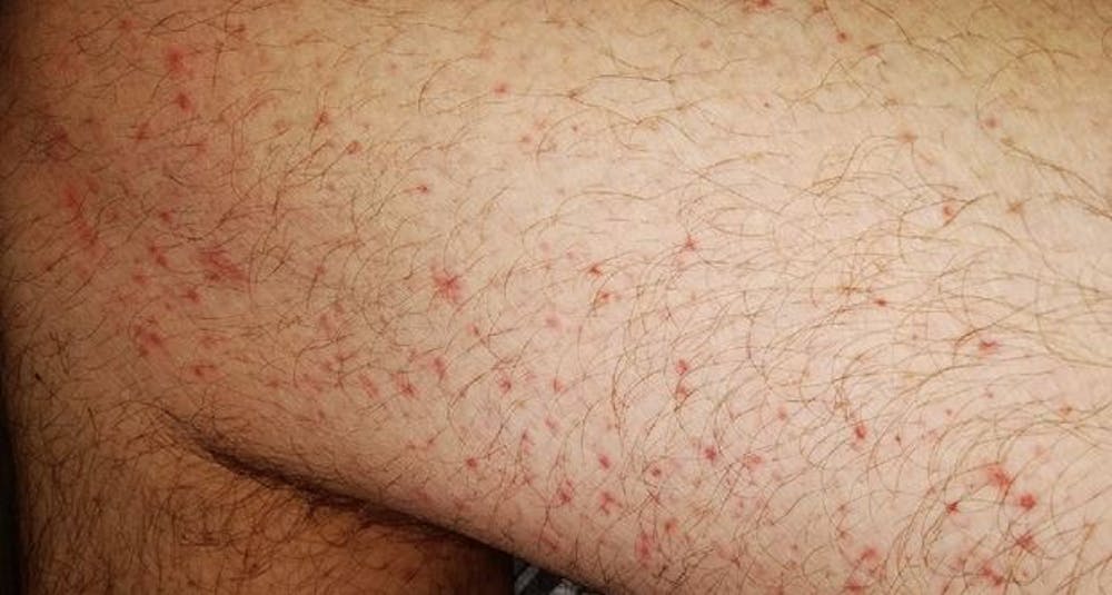 flat red rash on arms