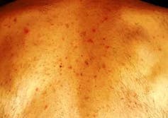 Vesicular eruptions, or water blisters, on the back