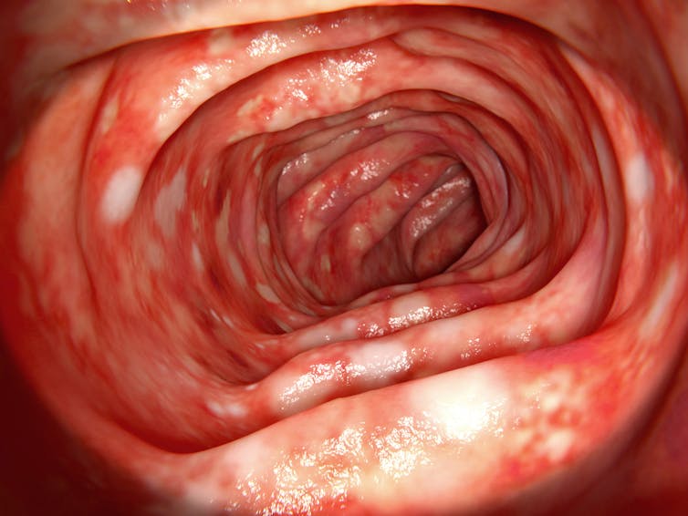 Colon affected by ulcerative colitis