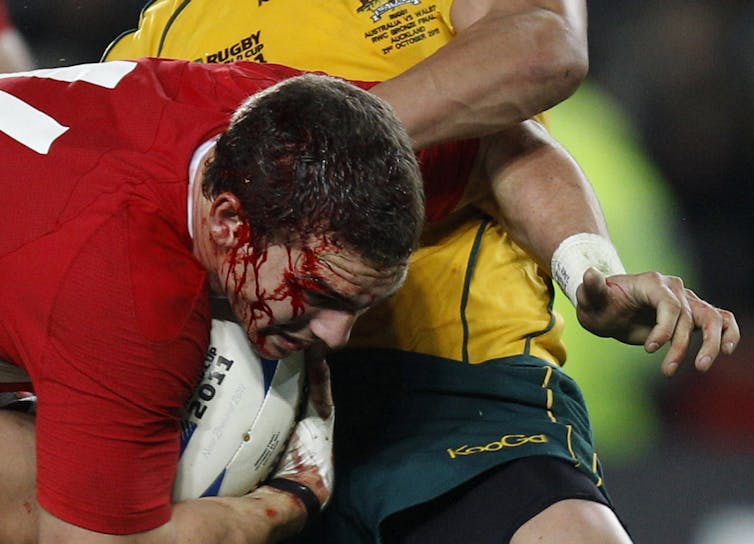 A man playing rugby with blood running from his head