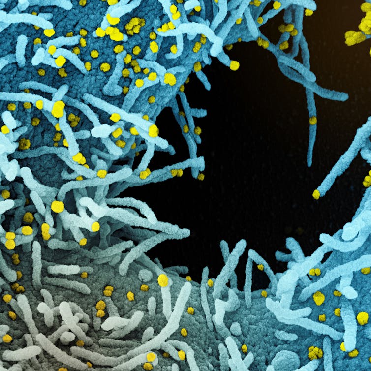 Micrographie électronique à balayage d’une cellule fortement infectée par des particules du virus du SRAS-CoV-2 (en jaune), isolée à partir d’un échantillon prélevé sur un patient. © NIAID/NIH