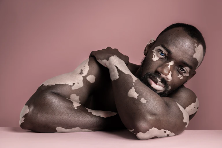Un hombre con manchas piel blanca y de color, como si padeciera vitíligo.