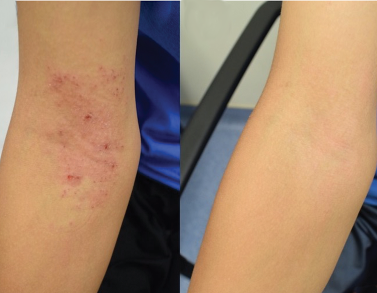 Live bacteria spray is showing promise in treating childhood eczema