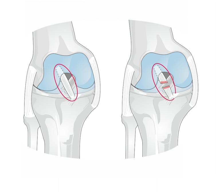 Anatomy of the knee showing a torn anterior cruciate ligament.