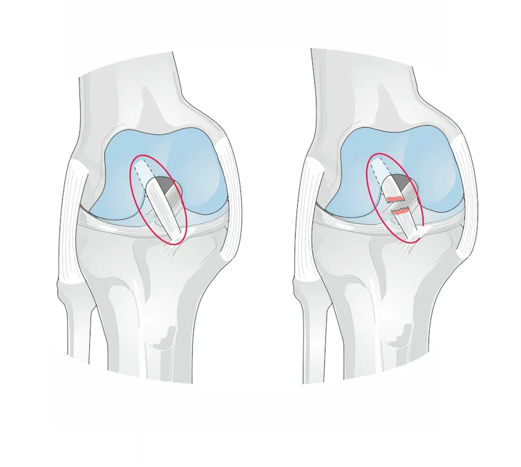 Anatomy of the knee showing a torn anterior cruciate ligament.