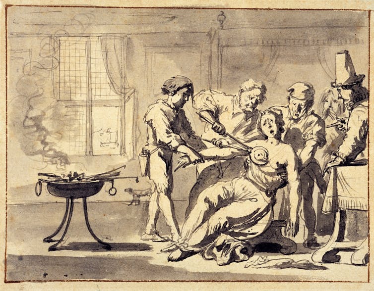 A pen and ink drawing of a 17th century doctor performing a mastectomy with hot tongs.