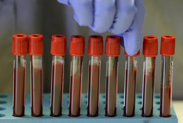 A purple-gloved hand is selecting one of nine vials of blood in a green stand.