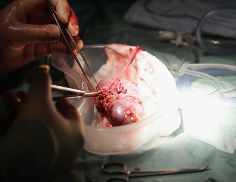 A surgeon prepares a kidney for transplant.