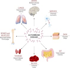 An autoimmune-like antibody response is linked with severe COVID-19