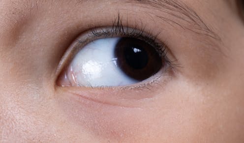 La aniridia es una enfermedad ocular grave que surge desde el nacimiento. Se caracteriza por un desarrollo incompleto o anómalo de una de las estructuras más visibles del ojo: el iris.