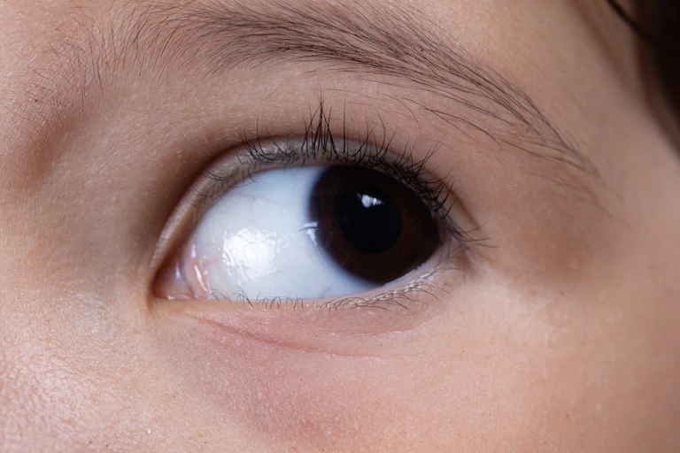 Ojo de un niño con aniridia.