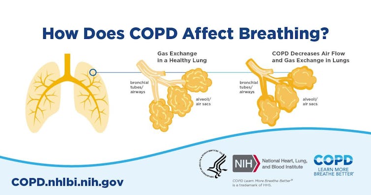 Cigarette smoke can reprogram cells in your airways, causing COPD to hang on after smoking ends