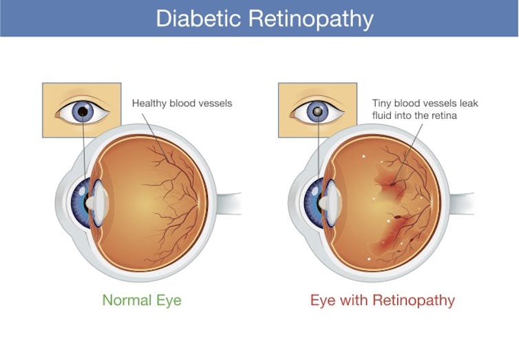 diabetes 2 eye treatment típusa